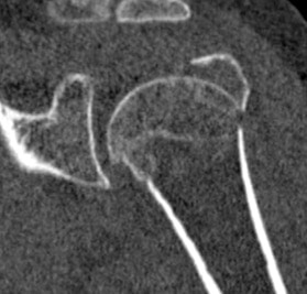 Imagen 1. Corte de escaner de fractura humero