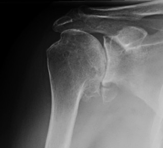 Imagen 1. Radiografía artrosis hombro derecho