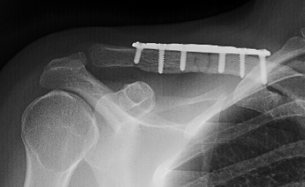 Imagen 2. Control fractura clavicula, reducción con placa y tornillos