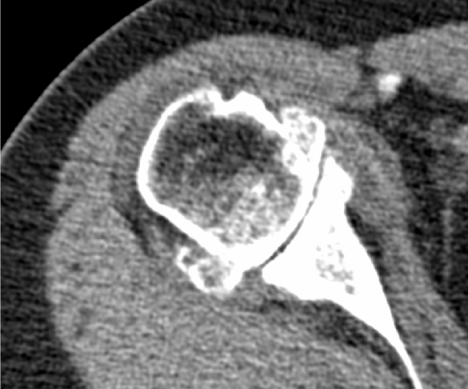 Imagen 2. Corte de escaner de artrosis hombro derecho