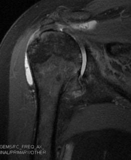 Imagen 3. Resonancia de hombro derecho con artrosis