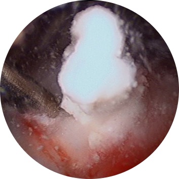 imagen 5. Apertura y limpieza de absceso cálcio en supraeaspinoso por artroscopia