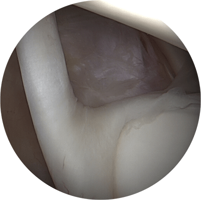 Imagen 1. Visión artroscópica intraarticular hombro